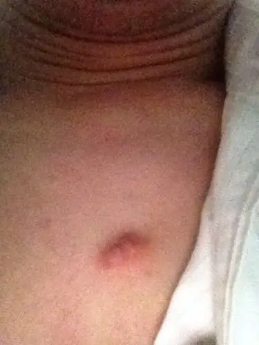 去医院医生建议手术割掉,我怕在胸膛中间一直没去做,有哪位知