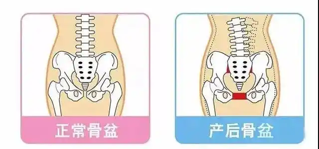产后骨盆修复为什么一定要做