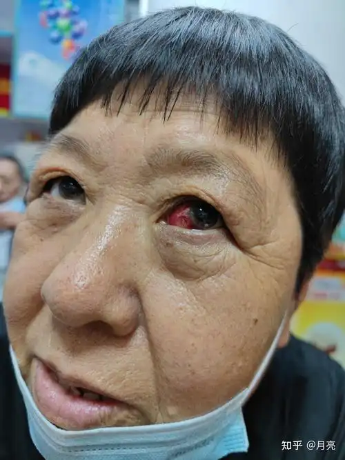 本草异解    张树才其实这个女人就是高血压引起的出血,长期的高血压