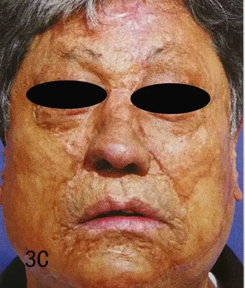 按照鼻亚单位进行鼻缺损修复 - 好大夫在线