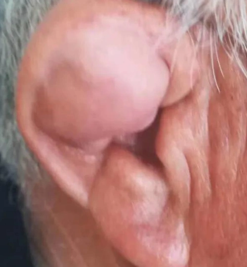 贵阳铭仁耳鼻喉医院:90%的人都误把耳廓假性囊肿当肿瘤,快看看有你吗?