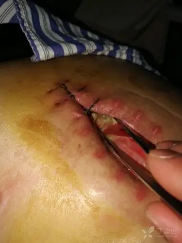 求教:一例切口感染并裂开的病例