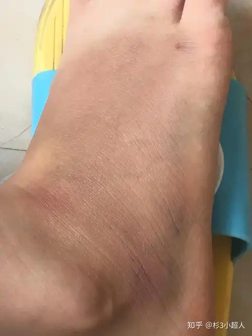 记得要冰敷 云南白药也不能停 我觉得还是有点用的红肿消退 开始淤青