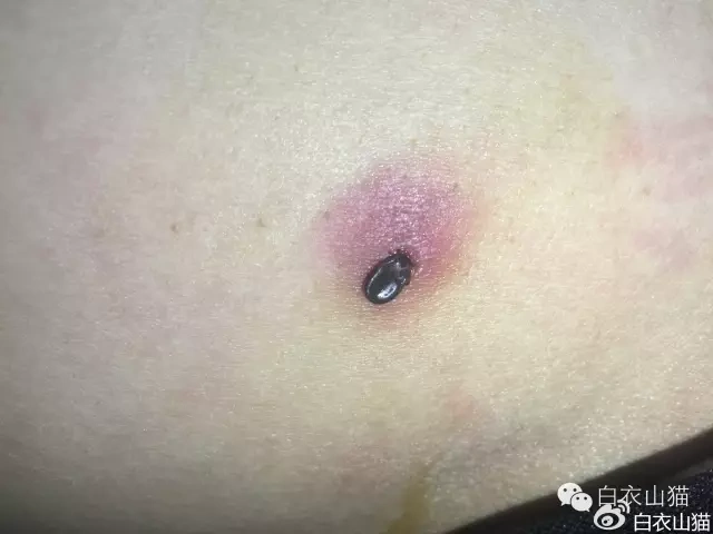 如何取出叮咬在皮肤上的致命蜱虫
