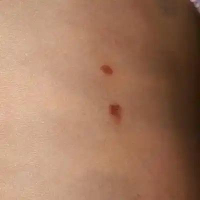 宝宝背上起了这两个红点,已经两天了,怎麼回事呢?