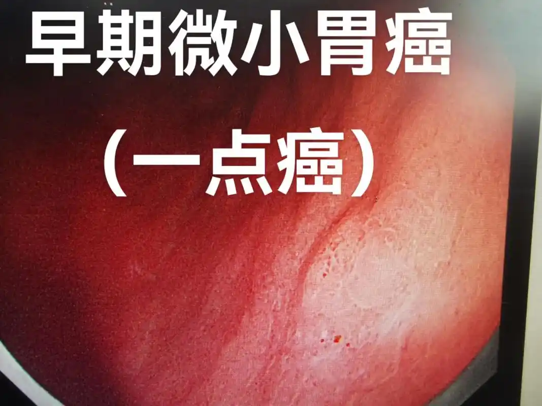 早期微小胃癌一例.