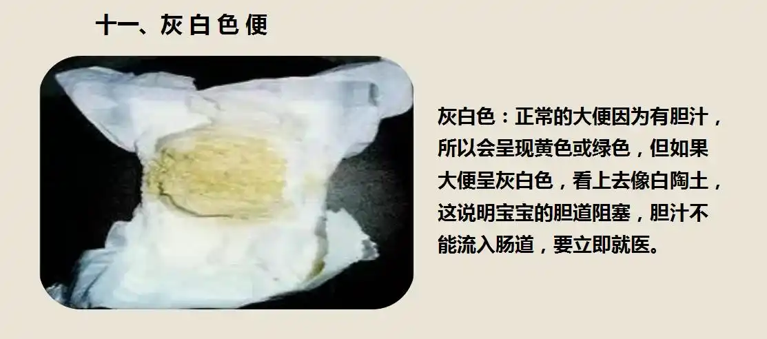 11,灰白色变10 ,暗红色便九,鲜红色便八,豆腐渣样便七,蛋花样便六,油