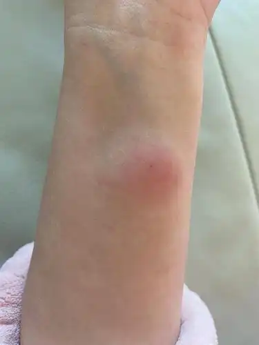 起床发现,肺结核皮试的第46个小时,我的手好肿,硬硬的,还有点痒.