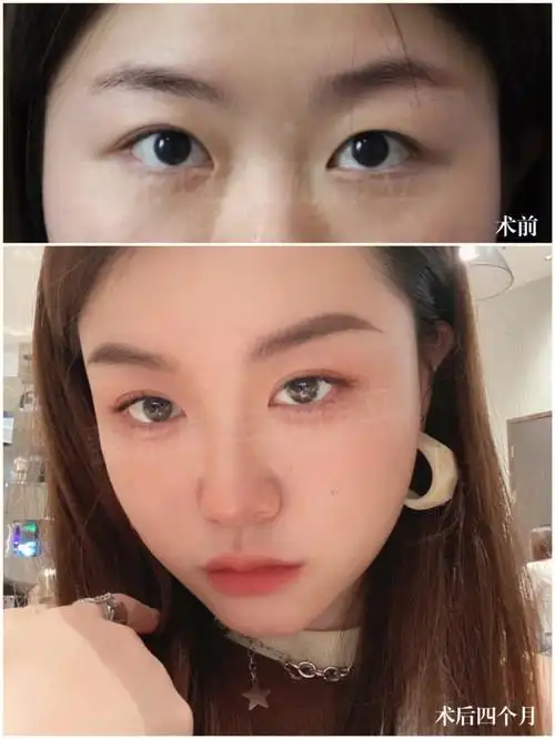 埋线双眼皮修复提肌修复术后四个月反馈