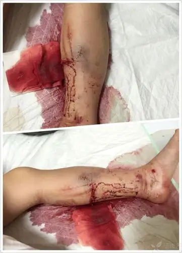 切换新版 >> 不再显示 ×查体:肢体略肿胀,小腿内侧中段后侧有一横行