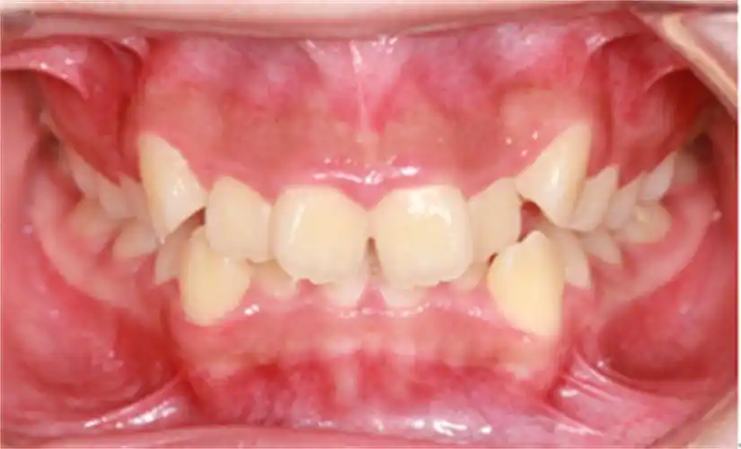 地包天,龅牙,孩子好自卑,牙科医生:别错过最佳矫正时机