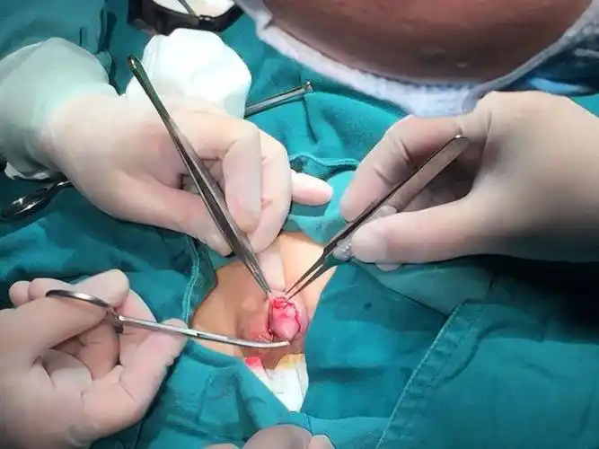 外科活动拯救尿道下裂