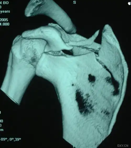 讨论这例肩胛骨骨折治疗方案