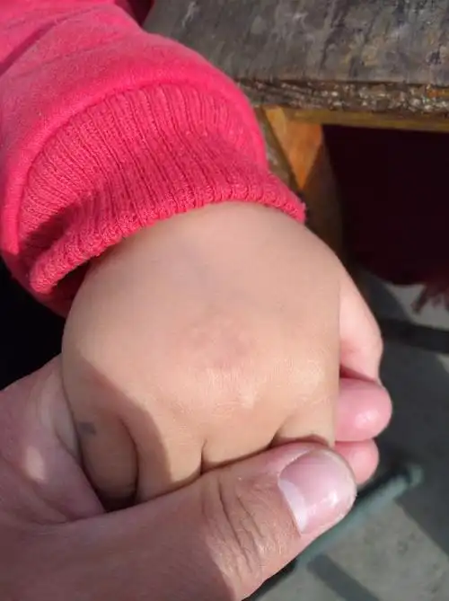 最近宝宝手上长岀一个圆圈状的皮肤病,谁知道