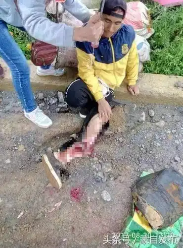 可怜!蒙自又一起车祸发生,他的脚