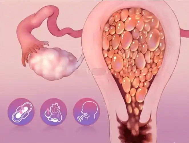 健康"锡"引力 | 葡萄胎的那些事儿