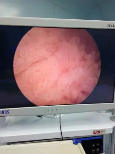 膀胱镜活检,病理结果回报膀胱低级别乳头状尿路上皮癌