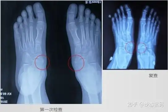 步态密码解析十七副舟骨