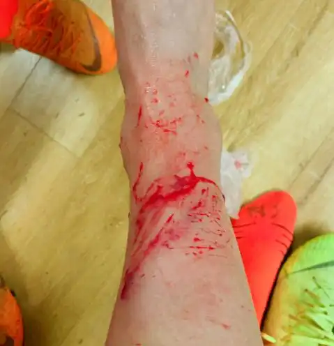 原创慎入!女足国脚赛后晒出受伤照片 右腿鲜血直流让人心疼