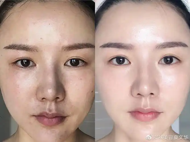 光子嫩肤治疗前后对比