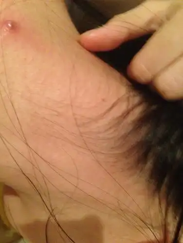 脖子后面一下长了个包 我颈椎痛 最开始没注意 是