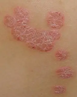 皮肤癌早期症状有哪些