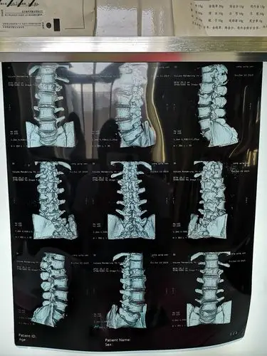 不断提升医疗服务水平,积极开展高端手术,近期,医院骨科开展了膝关节