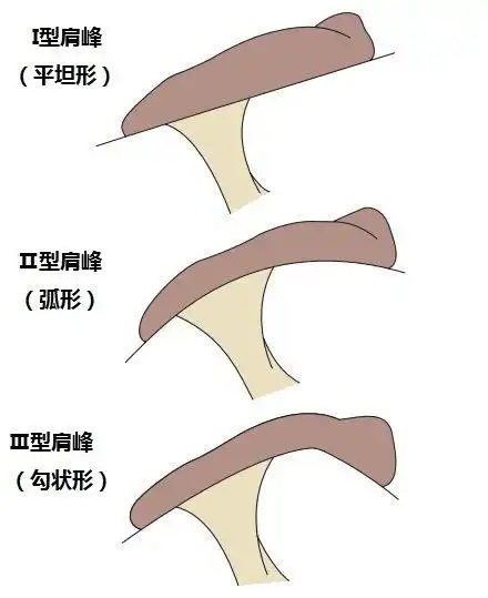 美国肩关节专家bigliani将肩峰形态分型分成哪三种类 - 好大夫在线