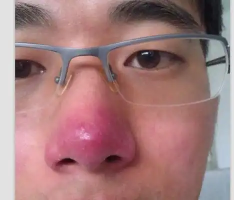 鼻甲肥大图片 (2)_有来医生