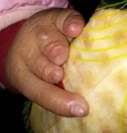 孩子手指短小怎么办?