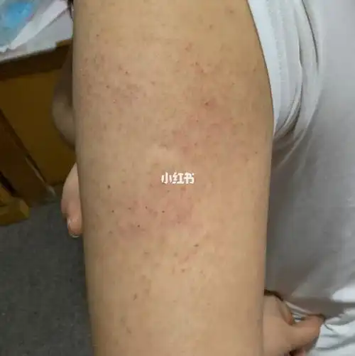 有和我一样手臂毛囊炎吗?有没治好?求治疗方法