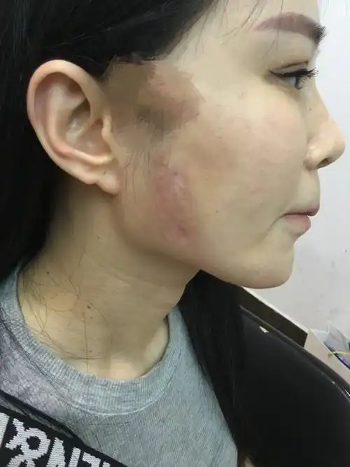 一直对自己的脸上有疤痕觉得很自卑,在新氧上查询和咨