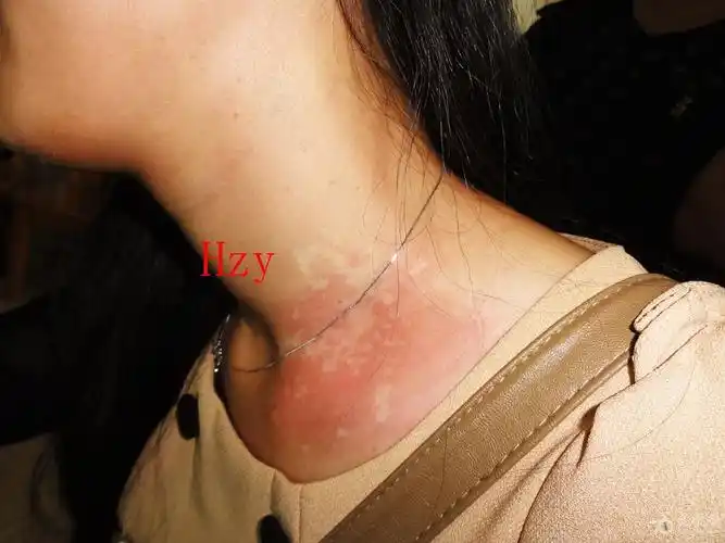 看图诊病2贫血痣