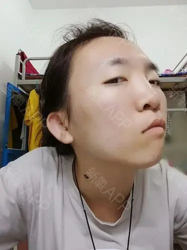 天津唇腭裂手术好不好_效果图_elvira88唇腭裂手术术后第45天_新氧