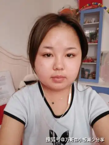 激素副作用满月脸 他却从未嫌弃_化验_因为_电话