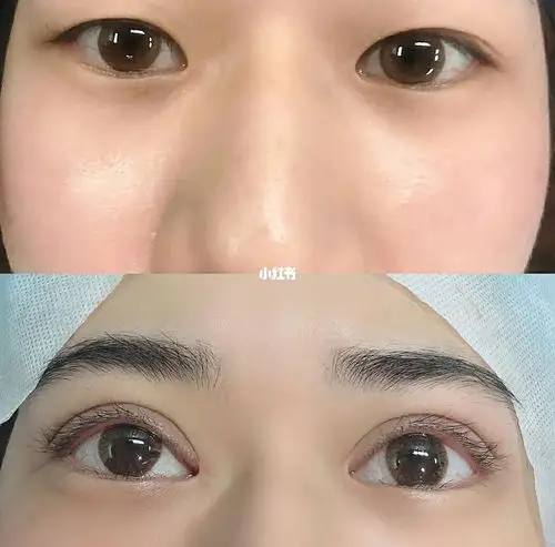 眼综合案例对比_美妆_医美_整容_美妆_医美整形