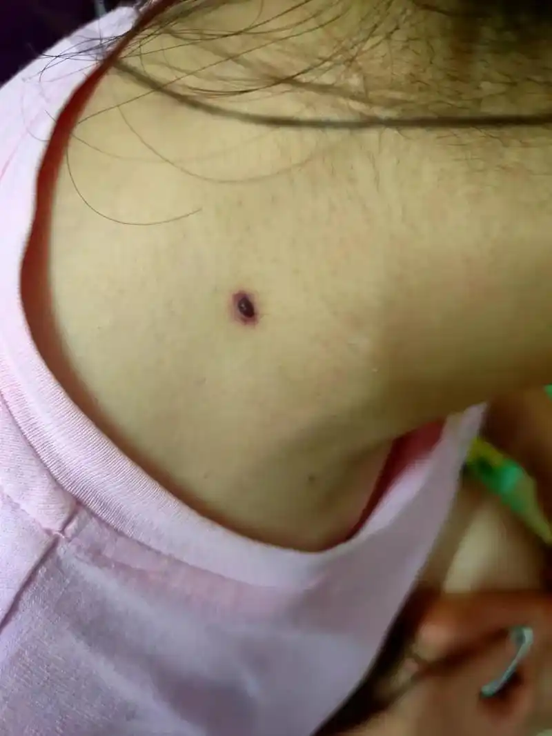 痣痣痣 ,从打小脖子上就有这颗皮肤一样的肉痣,昨天突然发现 - 抖音