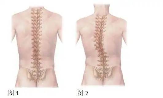 告诉你脊柱侧弯的危害