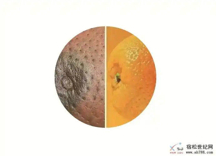 "酒窝征":乳腺皮肤出现一个小凹陷,像小酒窝一样.