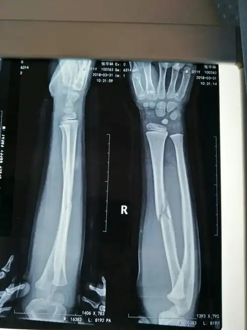 儿童尺桡骨双骨折在经我科手法整复小夹板外固定的治疗