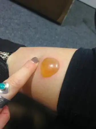 腿被蜘蛛咬出一颗「大蛋黄」 英女不敢就医组织坏死