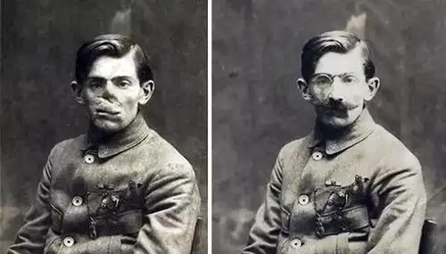 一战士兵因伤毁容成怪物全靠这张新脸来挽救尊严