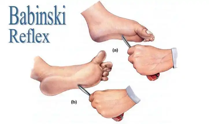 外八字,说明巴宾斯基反射没有整合如果巴宾斯基反射发展了,但尚未得到