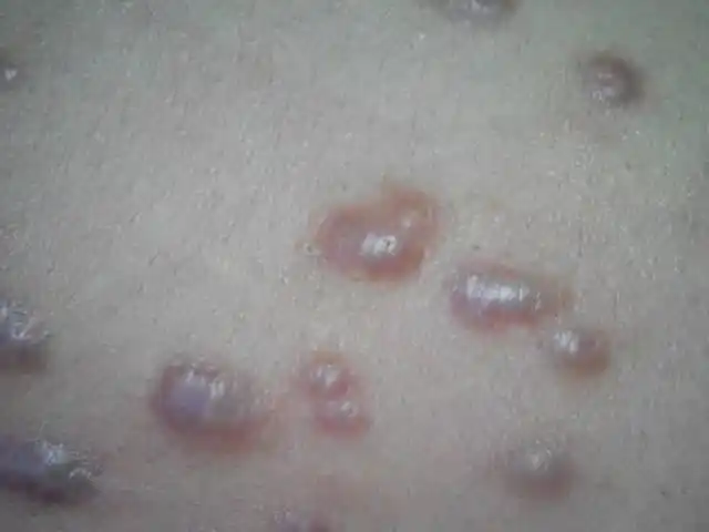 肩膀上也有.怎么治.什么引起的啊