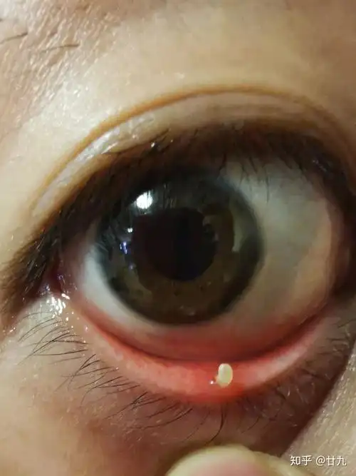 有没有得过外麦粒肿的朋友怎么个痊愈过程