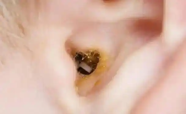 小儿出现这5个症状很可能是患上中耳炎了及早就医是关键