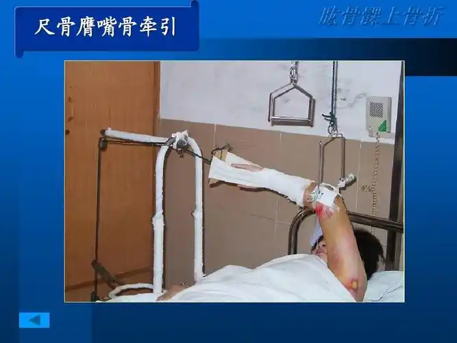 中医伤科骨折 尺骨膺嘴骨牵引 肱骨髁上骨折