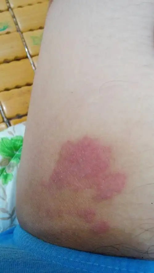 大腿两侧有红包和一小片红色斑,两处都很痒!