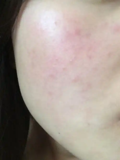 女生23-过敏体质.脸上总有湿疹,每个月都会发作至少一次.但是我