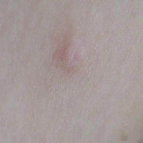 我只知道很多年了,不痛不痒,小时候没注意有没有